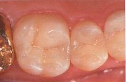 Inlay im Zahn